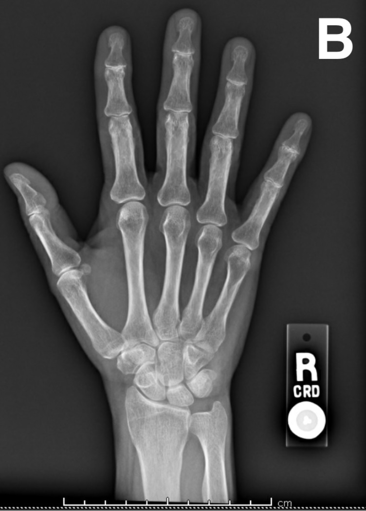 A Woman With Worsening Hand Pain and Stiffness Consultant360